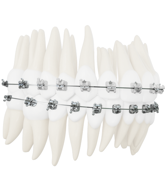 Braces